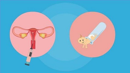 输卵管堵塞有哪些类型?可以做试管吗?